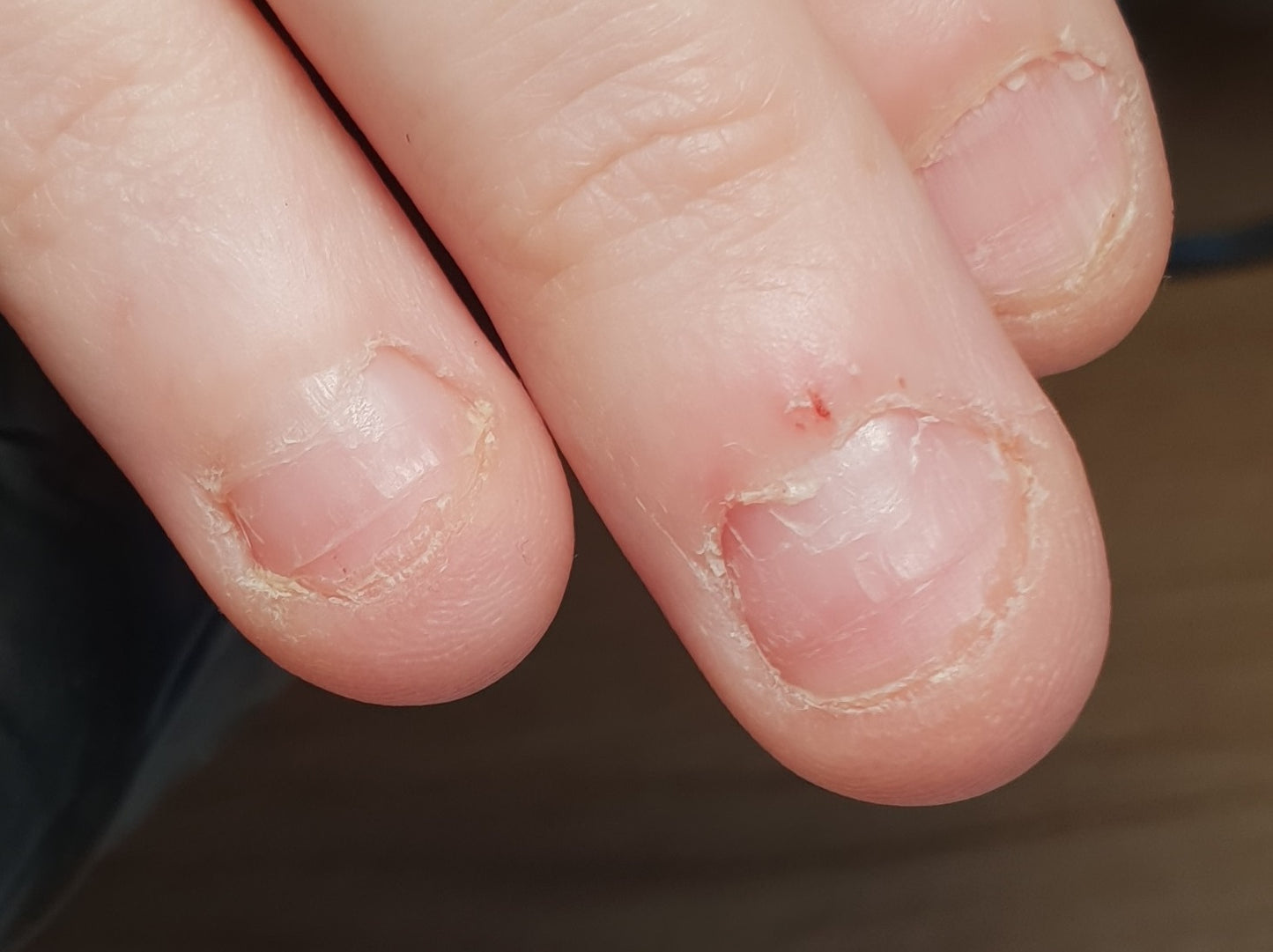 Nagelbijter training