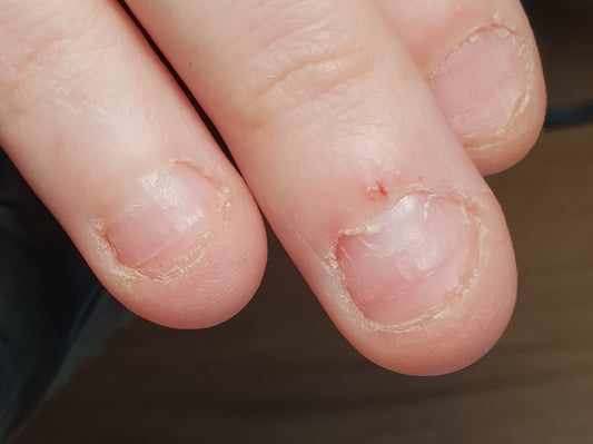 Nagelbijter training